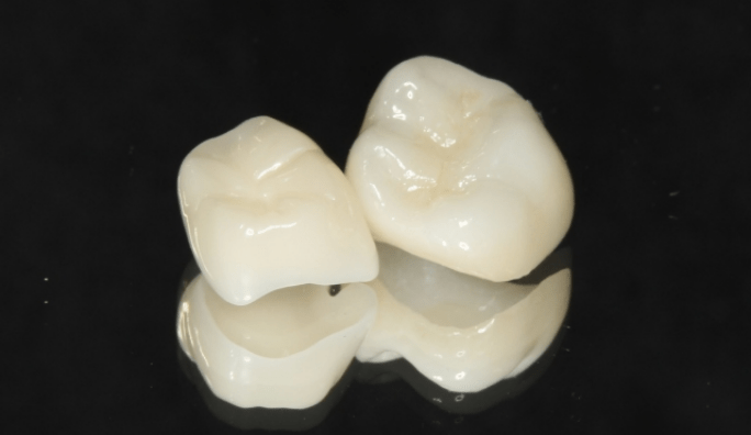 臼歯部（奥歯）に適したセラミックの種類