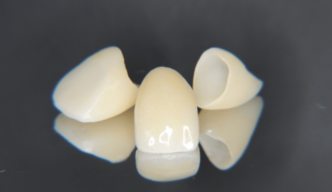 前歯部に適したセラミックの種類